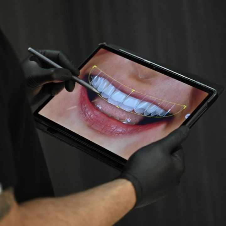 Where To get Teeth whitened in hong kong fokas dental Aesthetics and Implant Central Veneers Aligners